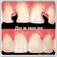 Художественная реставрация фронтального зуба это как Художественная реставрация фронтального зуба это как