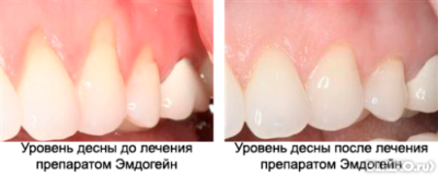 Опущение дёсен как лечить Опущение дёсен как лечить