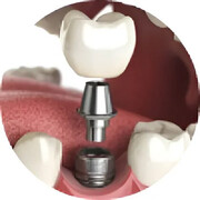 Скидка 32% на имплантацию зуба