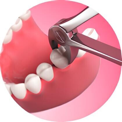 Скидка 31% на удаление зубов