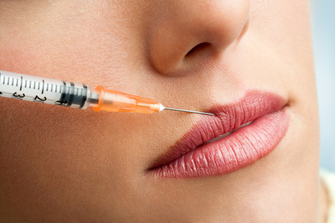Удаление гиалуроновой кислоты из губ препаратом лидаза/лонгидаза